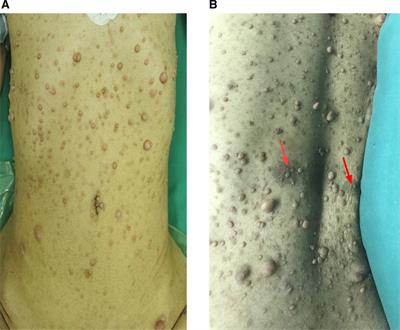 Laparoscopic retroperitoneal resection of the duodenal gastrointestinal stromal tumors in neurofibromatosis type 1; Case Report and literature review